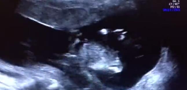 天津天孕醫(yī)院做四維怎么樣 看雙胞胎孕媽如何說