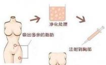 煤醫整形：自體脂肪豐胸的四大優勢