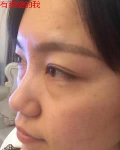 衛婭日記:我一直都以為眼袋對我的影響只是美觀,直到我了解了以后……