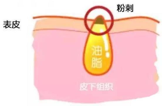 甲硝唑凝膠去黑頭要看主流,別拿個體差異混淆視聽