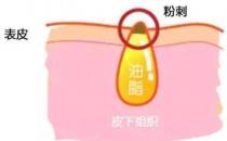 甲硝唑凝膠去黑頭要看主流，別拿個體差異混淆視聽