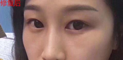 君雅筆記：眼袋過重，就會顯得比真實年齡大，要如何修復眼袋呢？