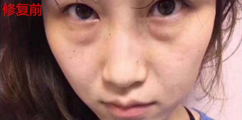 幻柔筆記:眼袋修復后氣質立現,怎么看都是青春靚麗!