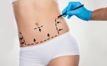 ?關于吸脂不得不說的秘密 吸脂減肥不適合哪些肥胖人群