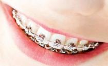 武漢德韓口腔揭秘關于牙齒矯正方案那些事兒