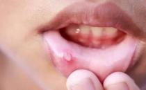 ?嘴角起小水泡怎么回事，嘴角起了一堆小水泡怎么辦
