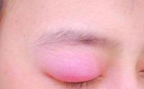 ?眼皮腫是怎么回事，眼皮腫是怎么快速消除